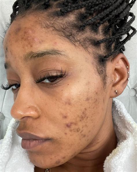 Keke Palmer Got Real About Her Acne From Polycystic Ovary Syndrome