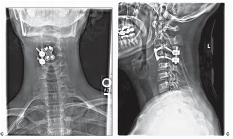 Complications In The Treatment Of Subaxial Cervical Fractures And
