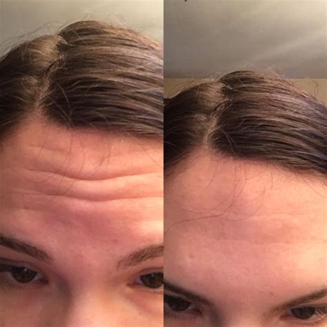 Routine Help 21 With Forehead Wrinkles Rskincareaddiction