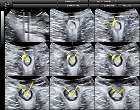 Transperineal Ultrasound Assessment Of The Anal Sphincter After My Xxx Hot Girl