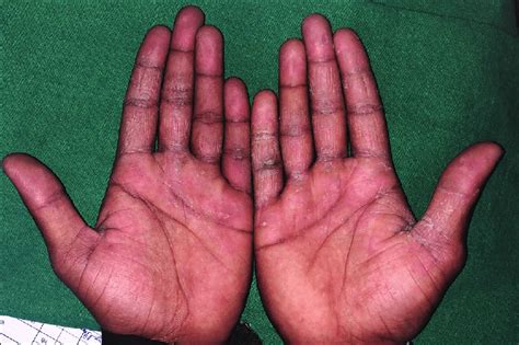Hand Dermatitis Due To Excessive Hand Washing Download Scientific Diagram
