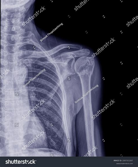 Xray Middleaged Man Broken Collarbone Examined Stock Photo 2207311267