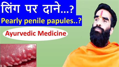 Pearly Penile Papules Gharelu Upay Ling Par Dane Ayurvedic Medicine