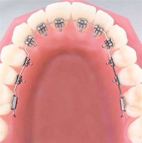 Incognito™ Braces Hidden Lingual Braces Confident Orthodontics