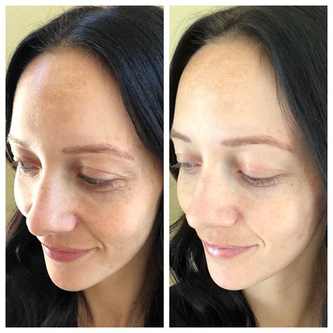 Glyton Chemical Peel Before And After Beauty Outfits And Outings