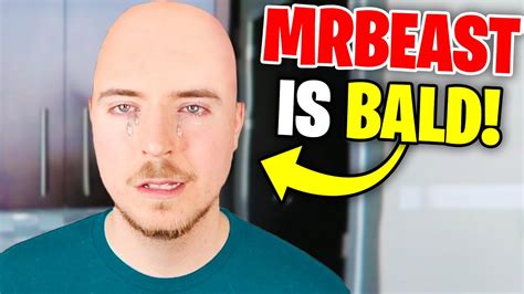 18 Why Is Mrbeast Bald Apalamikkayla