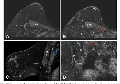 Figure 1 From Imaging Axillary Lymph Nodes In Patients With Newly