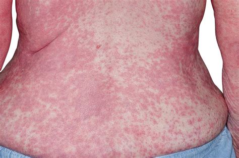 Skin Rash After General Anaesthetic Photograph By Dr P Marazziscience