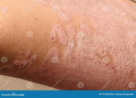 Diseases Caused By Abnormalities Of The Lymph Psoriasis Is A Skin