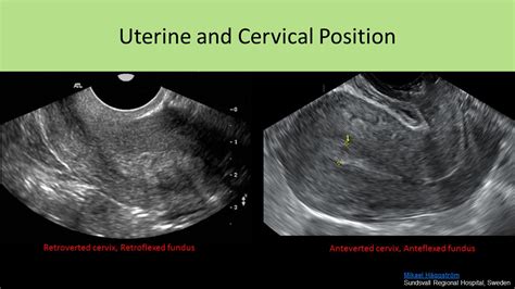 Retroverted Uterus Transabdominal Ultrasound