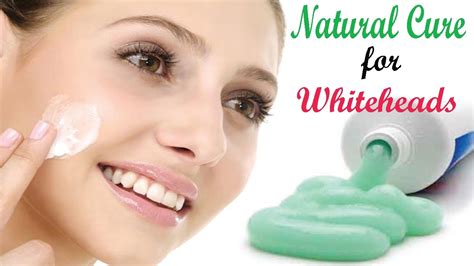 How To Get Rid Of Whitehead Natural Whitehead Treatment Youtube