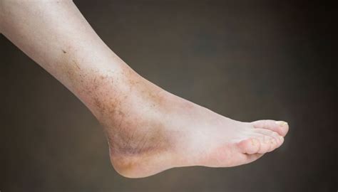 Swollen Ankle And Leg Causes Treatments And More