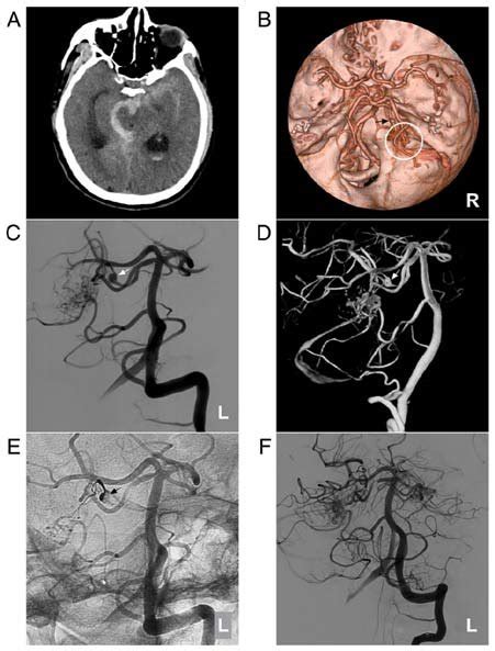 Avm Combined With A Prenidal Aneurysm On The Sca A Brain Ct Scan