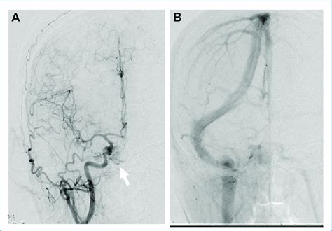 Cerebral Angiography Performed Before The Operation A Angiogram Of