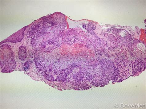 Squamous Cell Carcinoma Of Lip