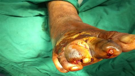 Wet Gangrene Diabetic Foot Osteomyelitis Toe Disarticulation Amputation Wound Debridement