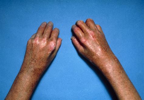 Scleroderma As Related To Skin Pictures