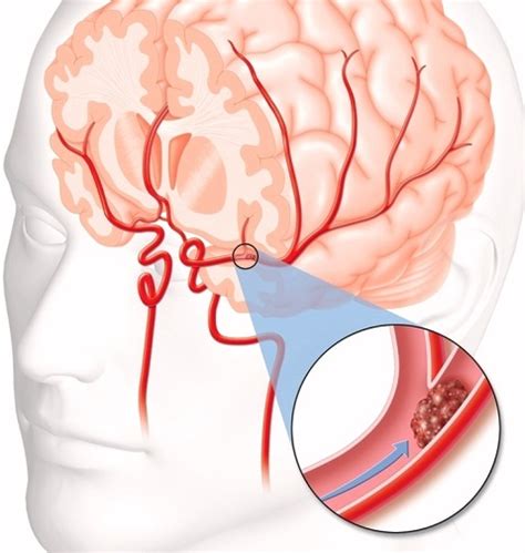 Blood clot is a passive item. What to Know and Do When Your Brain Has Blood Clots | MD ...