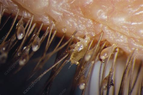 Lice On Eyelashes Stock Image M2400423 Science Photo Library