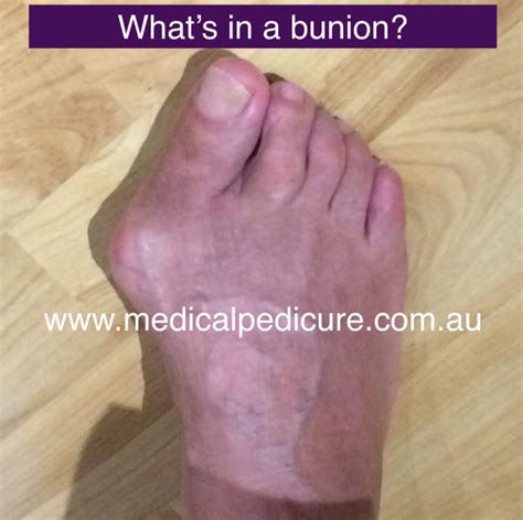 Why Do I Suffer From Bunions Podiatry Hq