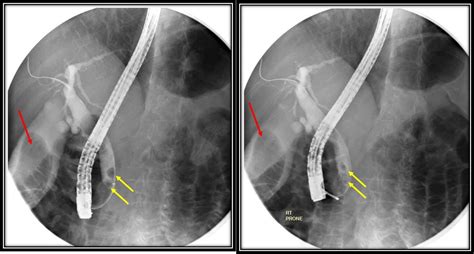 Endoscopic Removal Of Choledocholithiasis Radiology Cases