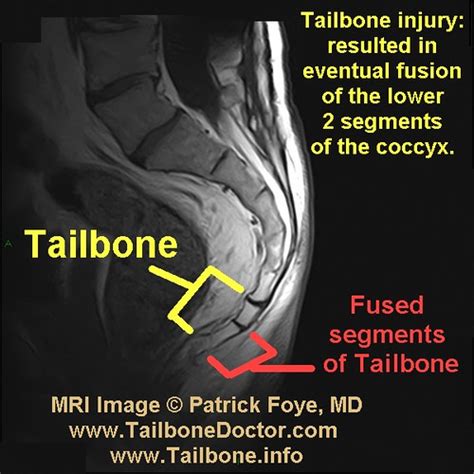 Tailbone Injury Pain Fracture Mri Fused Coccyx Foye Flickr