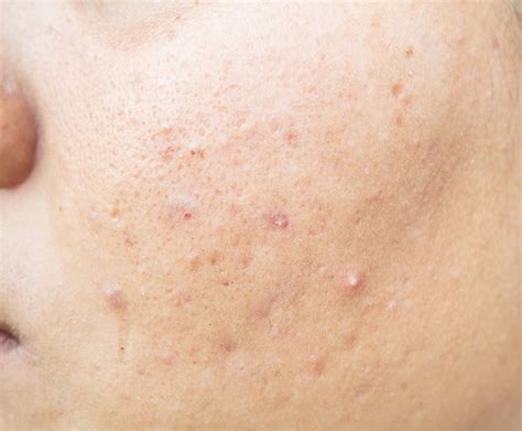 Premium Photo Scar From Acne On Face And Skin Problems And Pores In