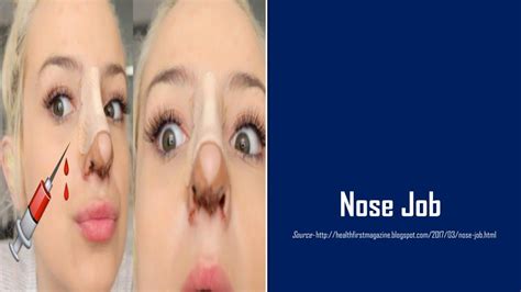 A Nose Job Also Called Rhinoplasty Is A Surgical Procedure To Change