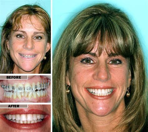 Braces Before And After Crowding Adult