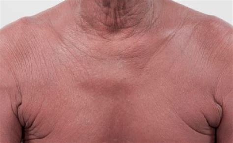 Lymphoma Skin Cancer Symptoms