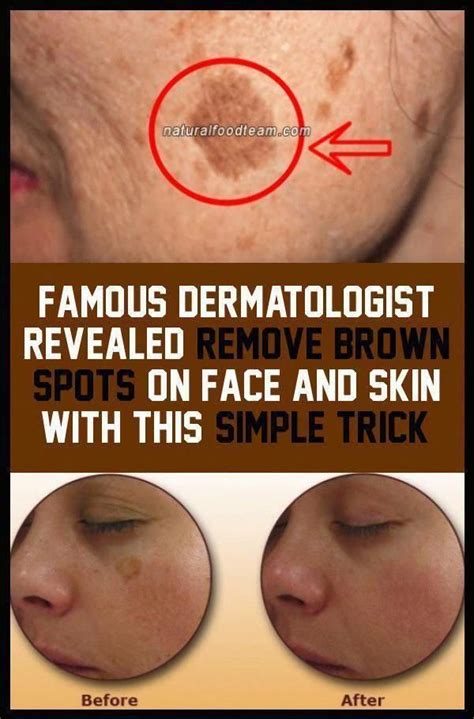 Remove Brown Spots On The Face And Skin With This Simple Trick