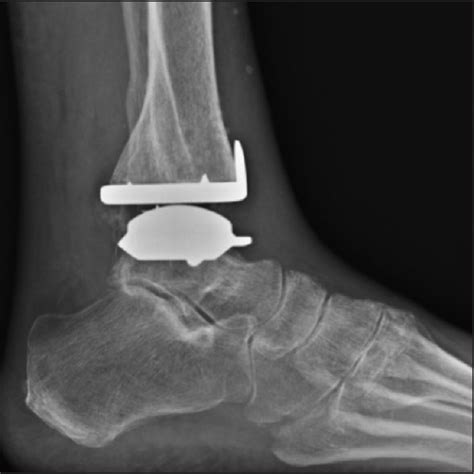 Sport And Physical Activities In Total Ankle Replacement Mobile And