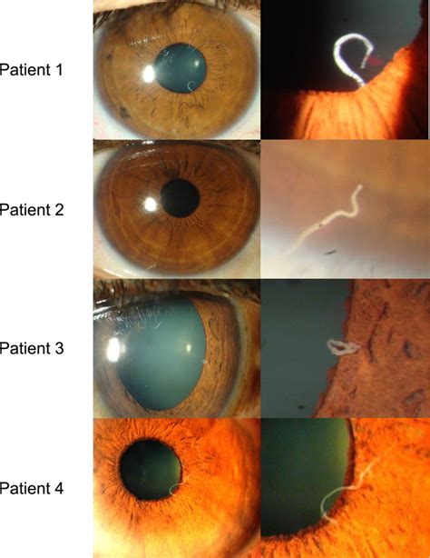 Case Report Management Of Dead Intraocular Helminth Parasites In