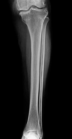 Lower Leg Xray Xray Image Of Leg Front View Xray Of Normal Leg Bone In