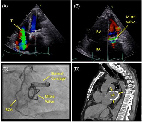 Long‐term Durability Of Starr‐edwards Disk Mitral Valve Prosthesis Over