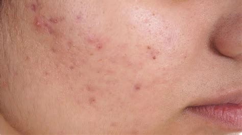 How can you get rid of fungal acne? how to get rid of fungal acne with head and shoulders ...