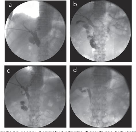 Figure 1 From Percutaneous Biliary Stent Placement In Palliation Of