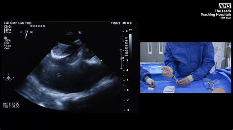 How To Start Using The Gore Cardioform Asd Occluder Four Simple Cases