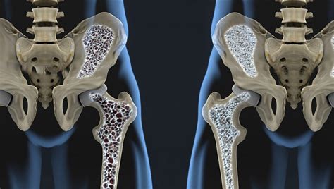 Bone Mineral Densitometry Dexa Exact Radiology