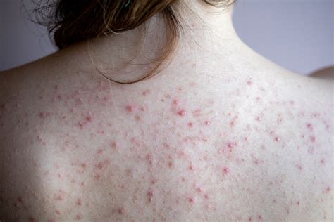 Acne On Back 7 Powerful Home Remedies To Get Rid Of It Healthwire