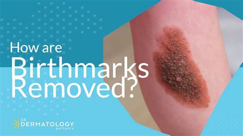 How Are Birthmarks Removed By Dermatologist Youtube