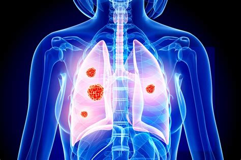 Lung Cancer Is Forgotten Disease Of Covid 19 Pandemic With 14000