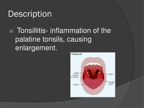 Ppt Tonsillitis Powerpoint Presentation Free Download Id2152221