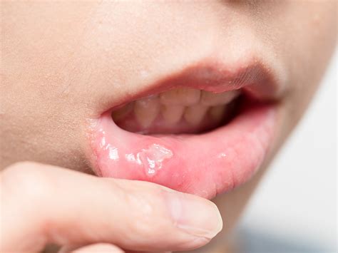 It may be on the surface of the tongue, the inside of the cheeks, the roof of the mouth (palate), the lips or gums. Signs Of Oral Cancer: What Not To Ignore - General and ...
