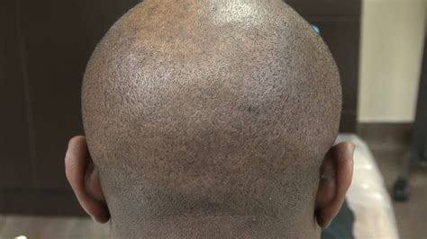Fue Hair Transplant Donor Scar 1 Year Follow Up Black Male Dr Diep