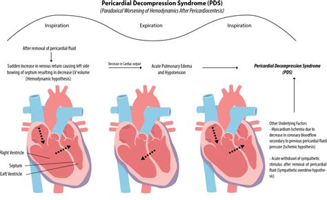 Pathophysiology Of Pericardial Effusion