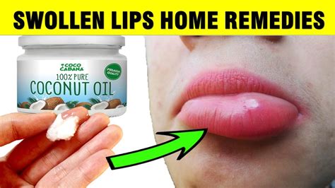 How To Treat Swollen Lips Naturally At Home Youtube
