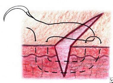 The needle is inserted in one side of wound approximately 5mm of wound edge procedure: Suturing Techniques Technique: General Principles ...