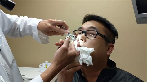 Nasal Stents Suck Septoplasty Turbinate Reduction Youtube