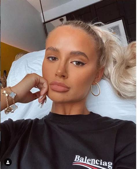 Molly Mae Hague Doesnt Miss Her Lumpy Horrible Lip Fillers And Says